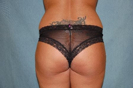Brazilian Butt Lift before at Christopher Saunders, MD in Chadds Ford, PA