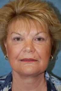 Blepharoplasty after at Christopher Saunders, MD in Chadds Ford, PA