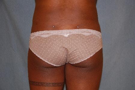 Brazilian Butt Lift before at Christopher Saunders, MD in Chadds Ford, PA