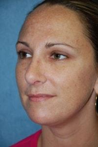 Christopher Saunders, MD chin implant after — Chadds Ford, PA