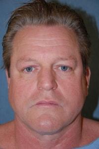 Christopher Saunders, MD facelift after — Chadds Ford, PA