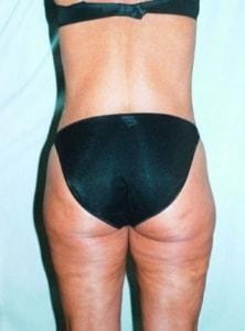 Thigh Lift after at Christopher Saunders, MD in Chadds Ford, PA