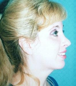 Christopher Saunders, MD rhinoplasty after — Chadds Ford, PA