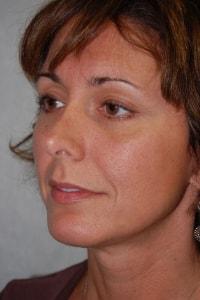 Christopher Saunders, MD chin implant after — Chadds Ford, PA