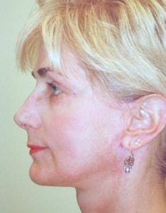 Christopher Saunders, MD facelift after — Chadds Ford, PA