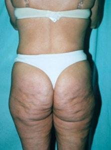 Thigh Lift before at Christopher Saunders, MD in Chadds Ford, PA
