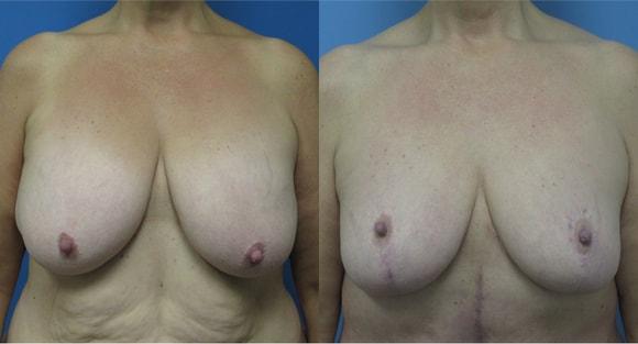 Breast Reduction result at Denver Plastic Surgery and Aesthetics in Denver, CO
