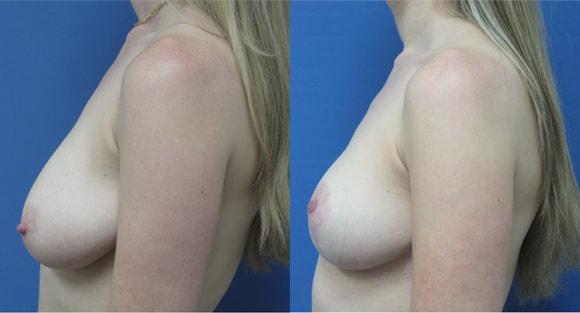Breast Reduction result at Denver Plastic Surgery and Aesthetics in Denver, CO