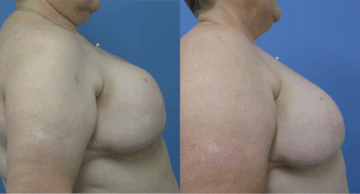 Denver Plastic Surgery and Aesthetics breast augmentation result — Denver, CO