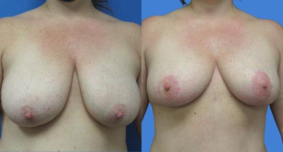 Breast Reduction result at Denver Plastic Surgery and Aesthetics in Denver, CO