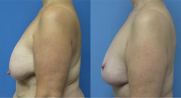 Breast Reduction result at Denver Plastic Surgery and Aesthetics in Denver, CO