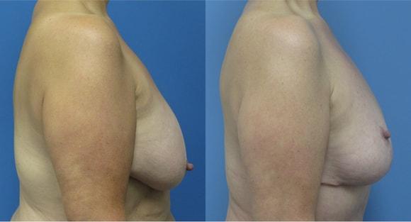 Breast Reduction result at Denver Plastic Surgery and Aesthetics in Denver, CO