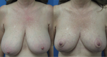 Denver Plastic Surgery and Aesthetics breast augmentation result — Denver, CO