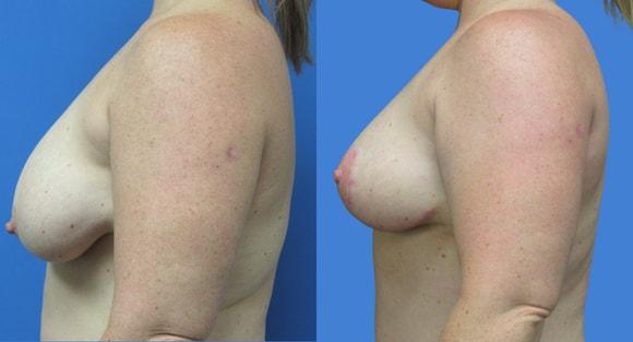 Breast Reduction result at Denver Plastic Surgery and Aesthetics in Denver, CO