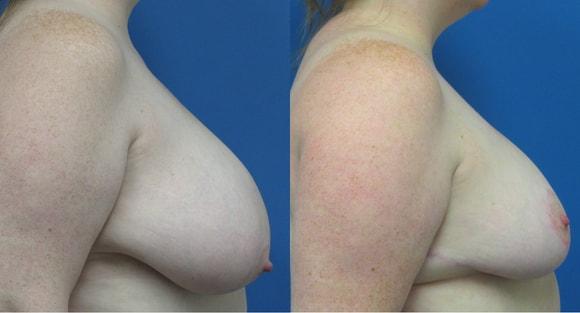 Breast Reduction result at Denver Plastic Surgery and Aesthetics in Denver, CO