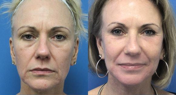 Laser Skin Resurfacing result at Denver Plastic Surgery and Aesthetics in Denver, CO