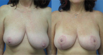 Denver Plastic Surgery and Aesthetics breast augmentation result — Denver, CO