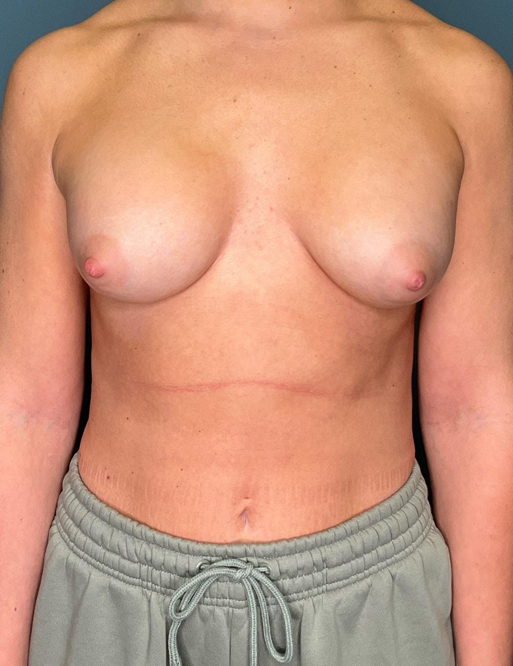 Wingate Plastic Surgery mommy makeover after — Berwyn, PA