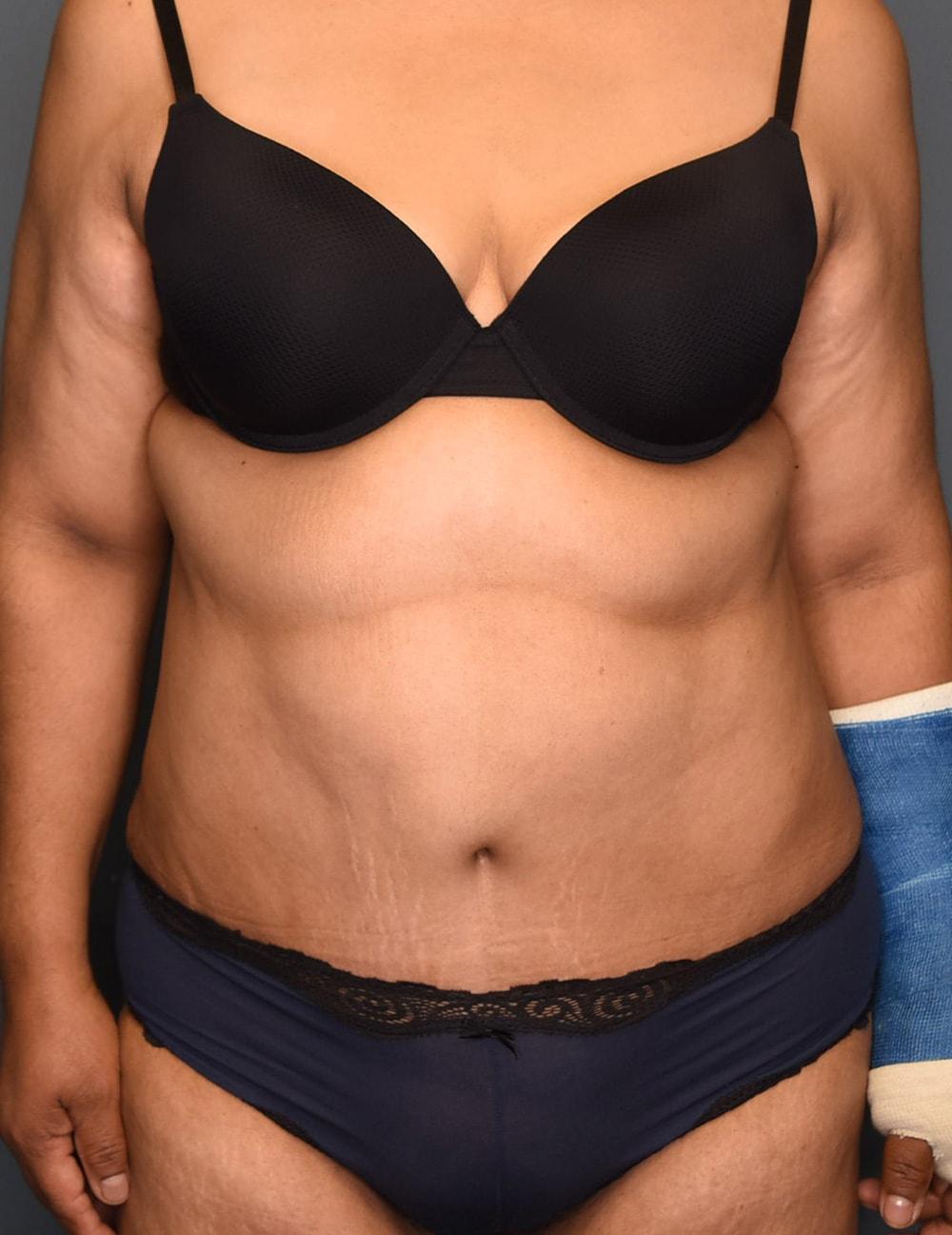 Wingate Plastic Surgery tummy tuck after — Berwyn, PA