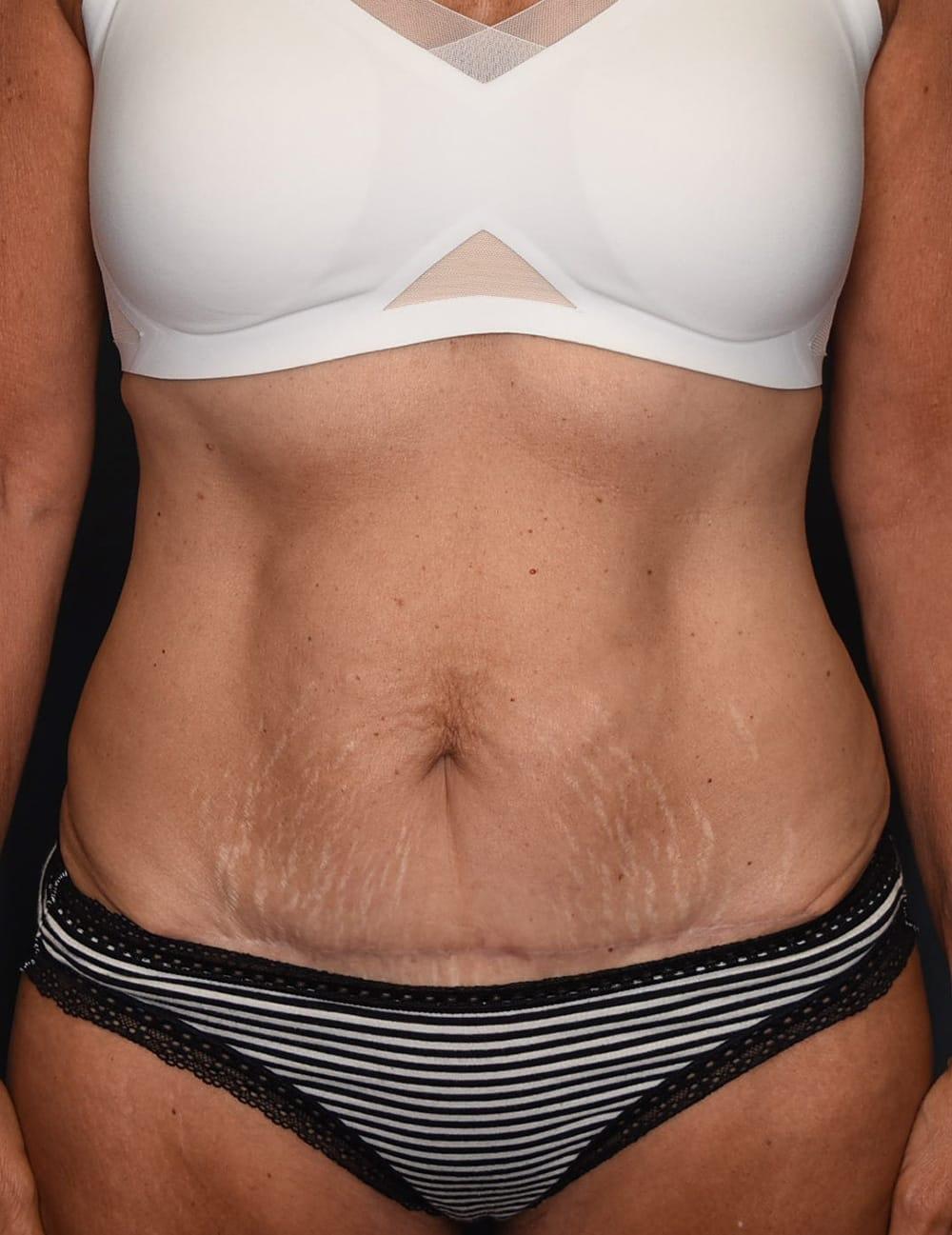 Wingate Plastic Surgery tummy tuck after — Berwyn, PA