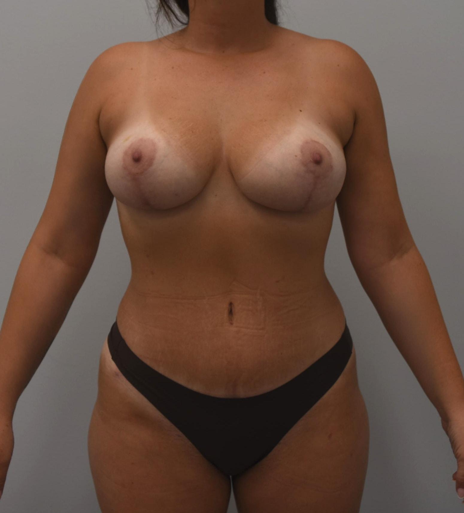 Wingate Plastic Surgery mommy makeover after — Berwyn, PA