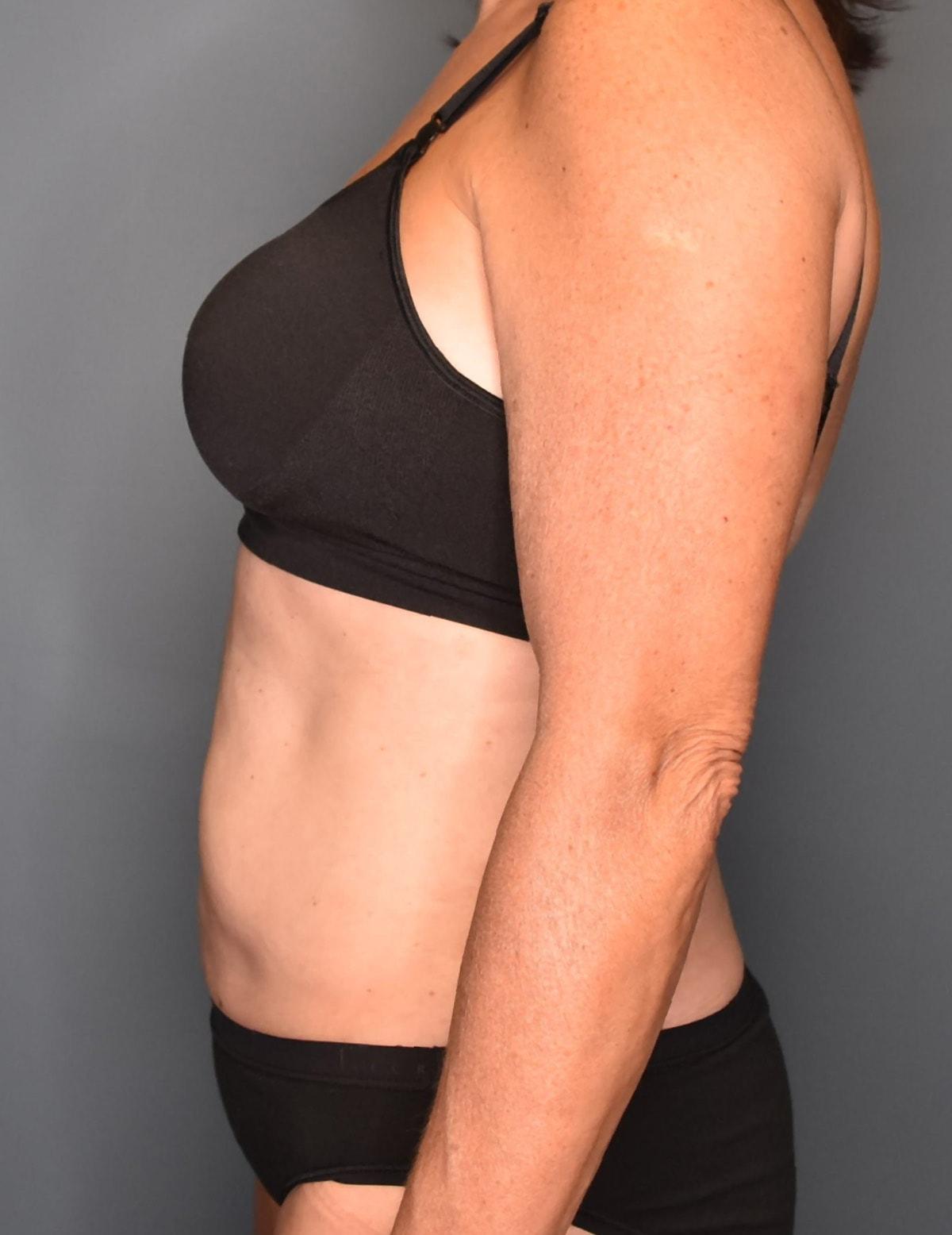 Wingate Plastic Surgery liposuction after — Berwyn, PA