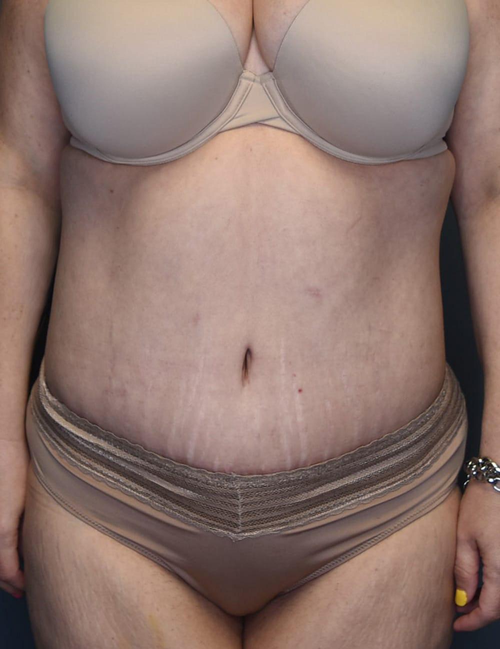 Wingate Plastic Surgery tummy tuck after — Berwyn, PA