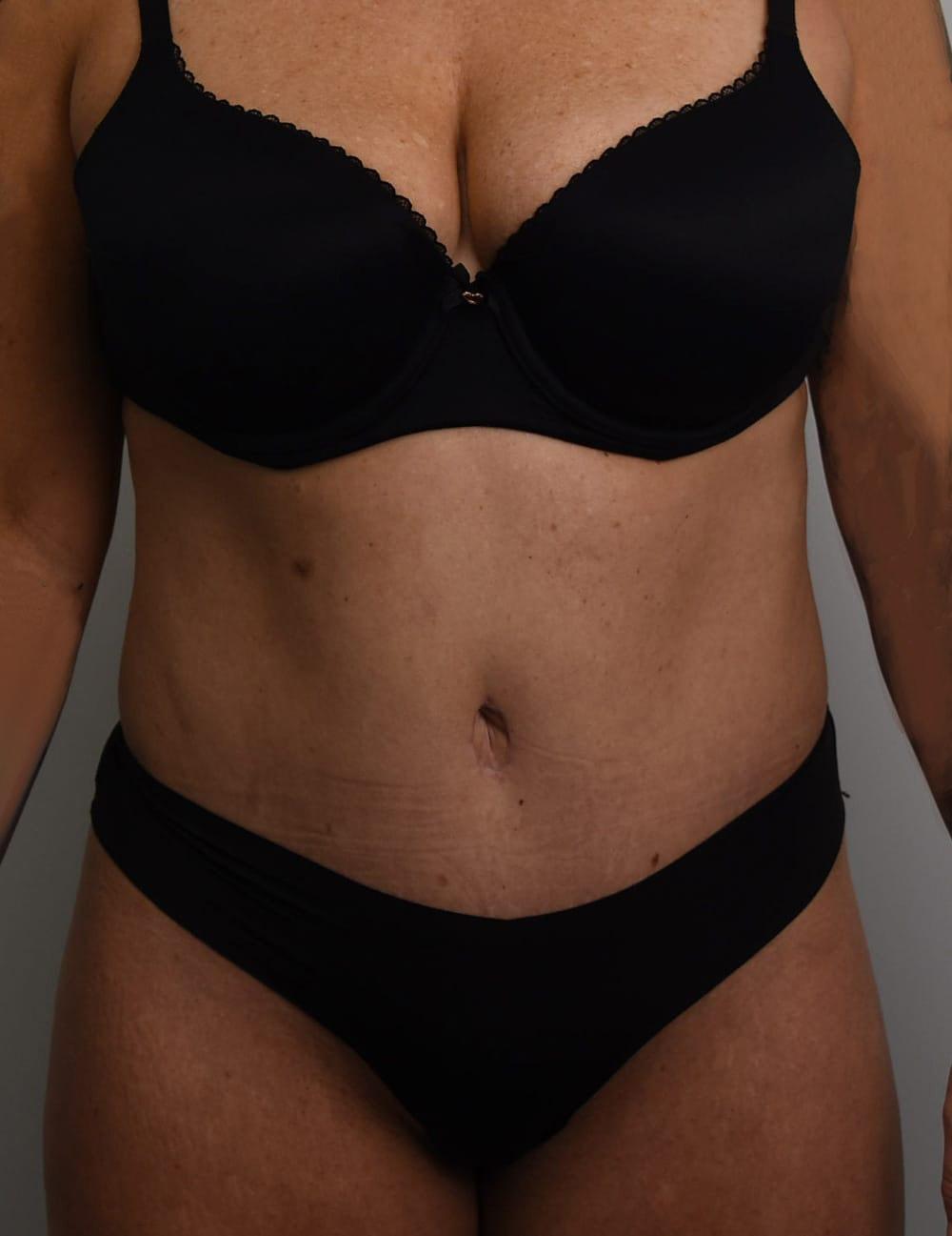 Wingate Plastic Surgery tummy tuck after — Berwyn, PA