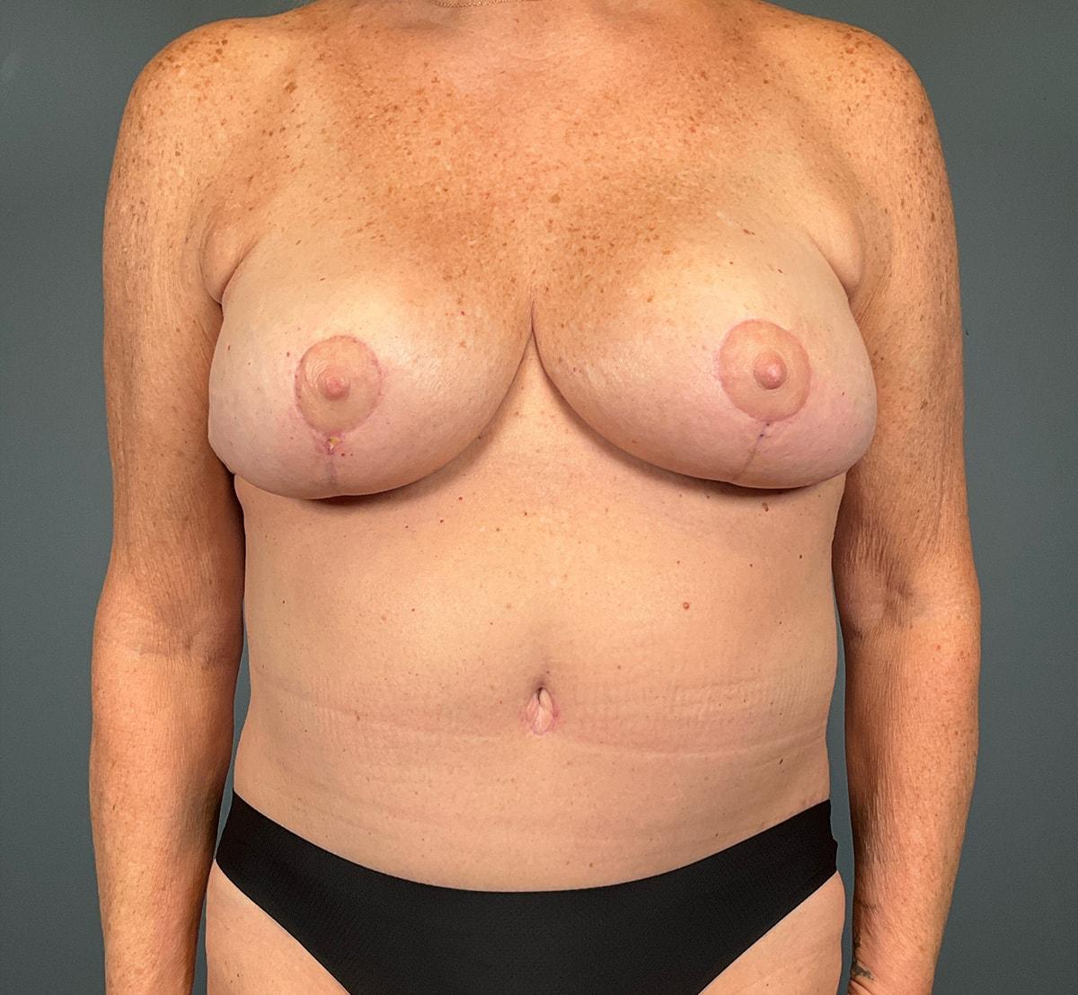 Wingate Plastic Surgery mommy makeover after — Berwyn, PA