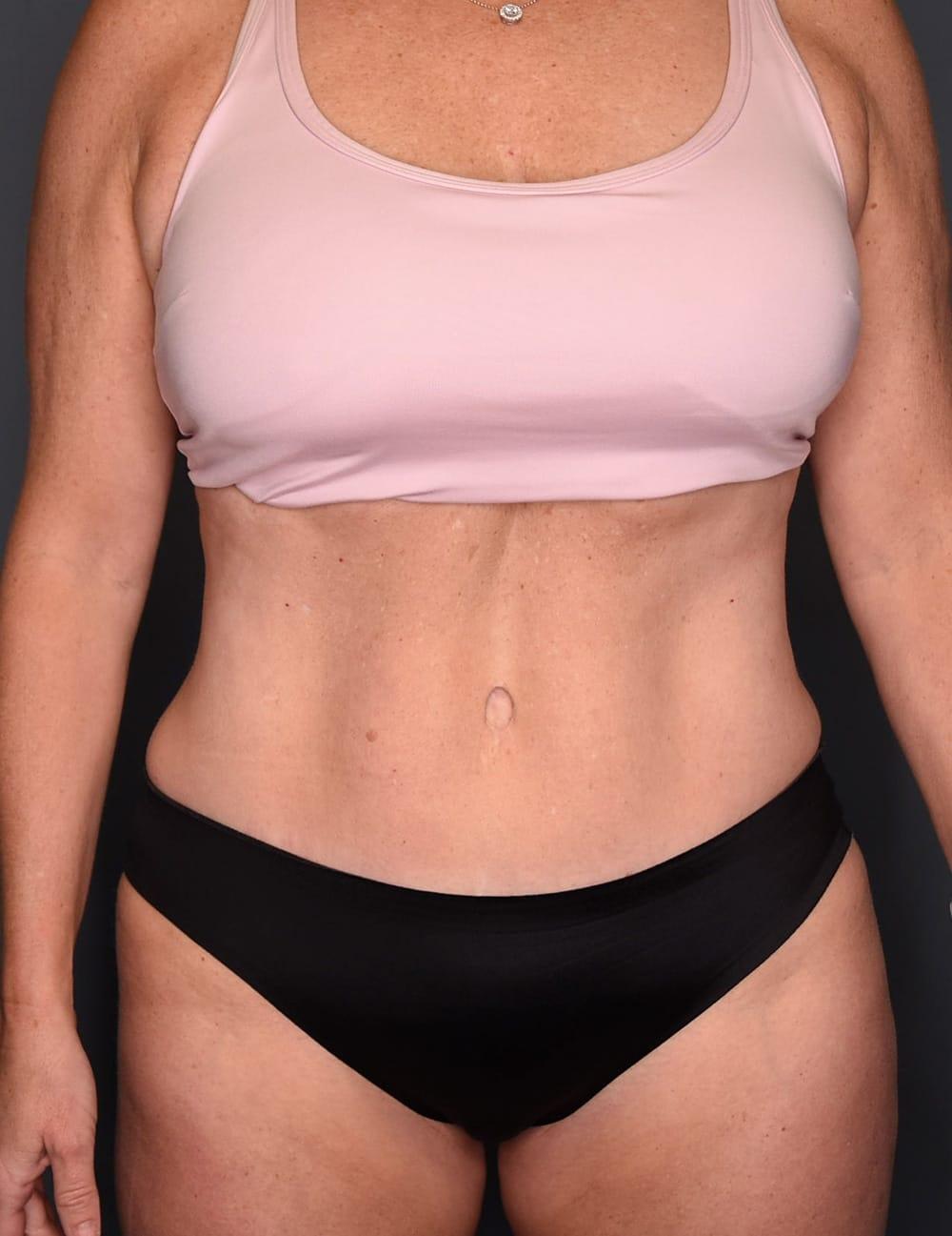 Wingate Plastic Surgery tummy tuck after — Berwyn, PA