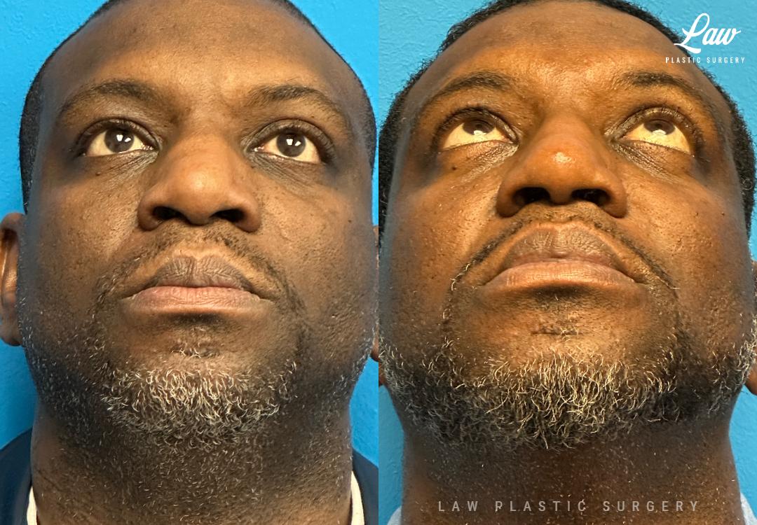 Huay-Zong Law, MD - Law Plastic Surgery rhinoplasty result — Dallas, TX