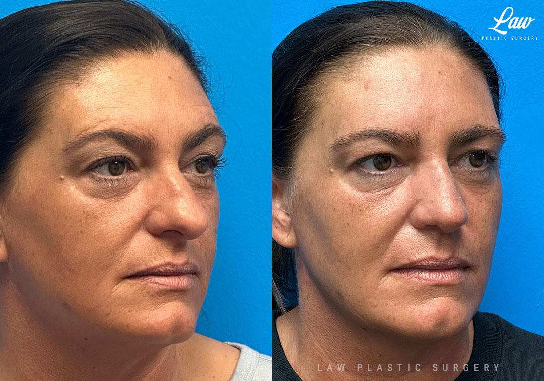 Huay-Zong Law, MD - Law Plastic Surgery rhinoplasty result — Dallas, TX