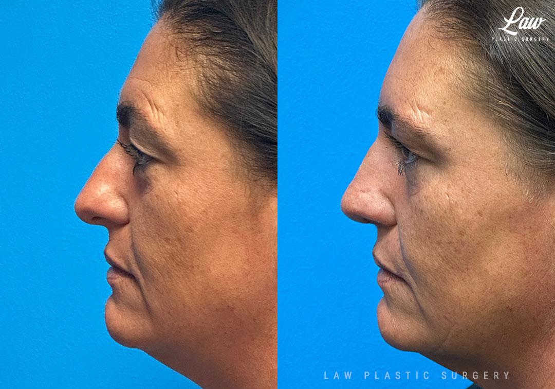 Huay-Zong Law, MD - Law Plastic Surgery rhinoplasty result — Dallas, TX
