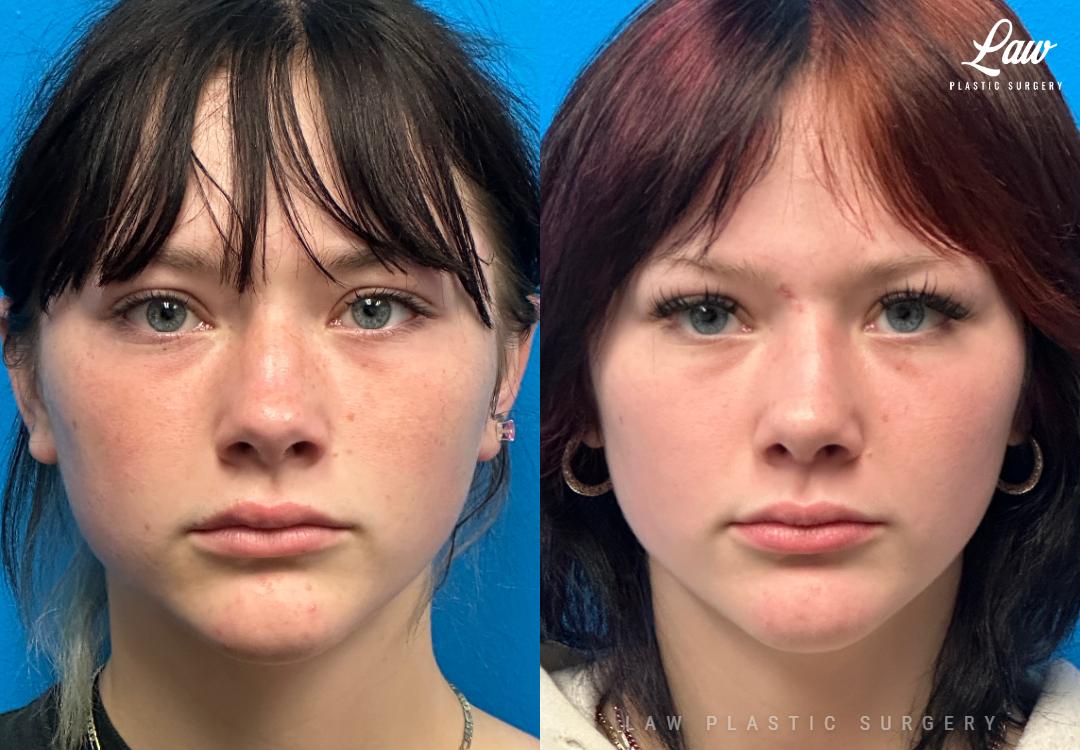 Huay-Zong Law, MD - Law Plastic Surgery rhinoplasty result — Dallas, TX