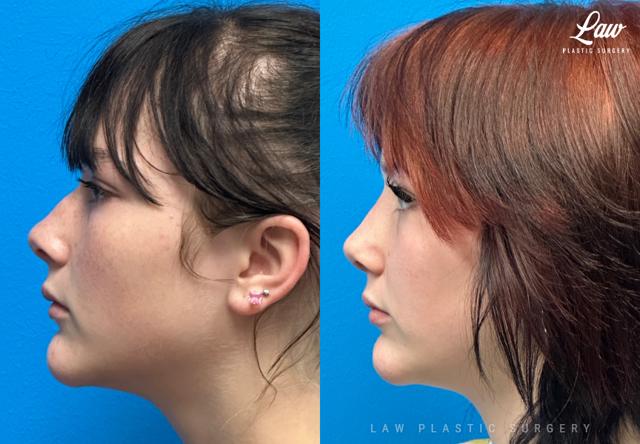Liquid Rhinoplasty result at Huay-Zong Law, MD - Law Plastic Surgery in Dallas, TX