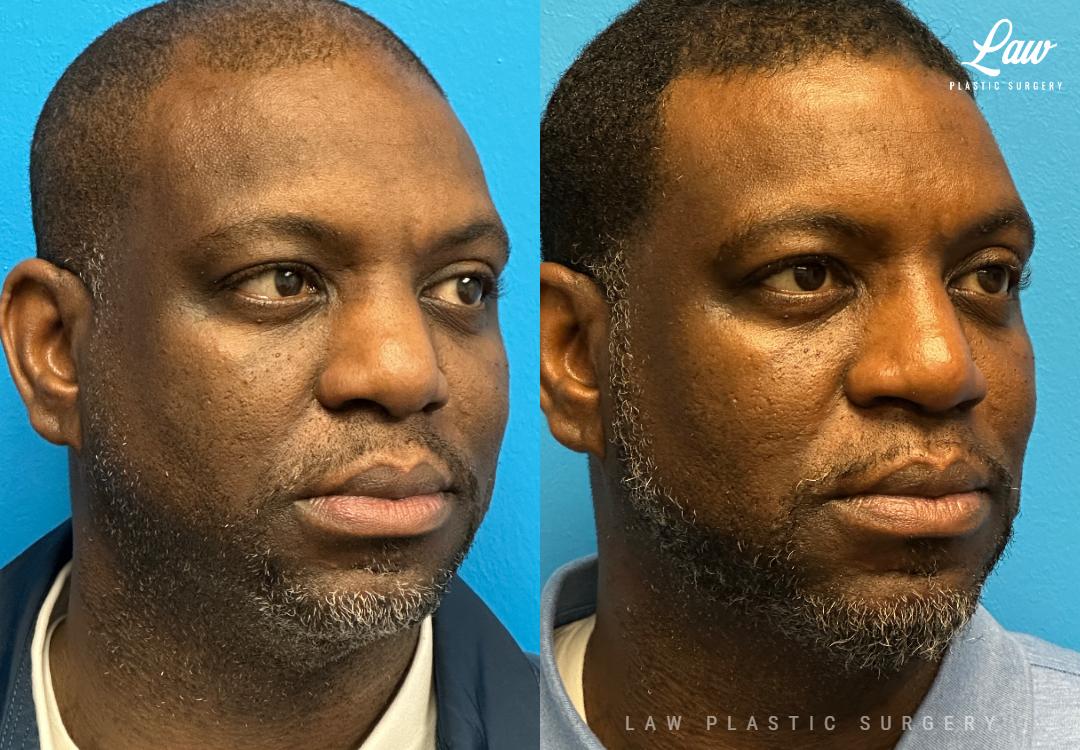 Huay-Zong Law, MD - Law Plastic Surgery rhinoplasty result — Dallas, TX