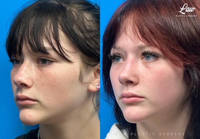 Liquid Rhinoplasty result at Huay-Zong Law, MD - Law Plastic Surgery in Dallas, TX