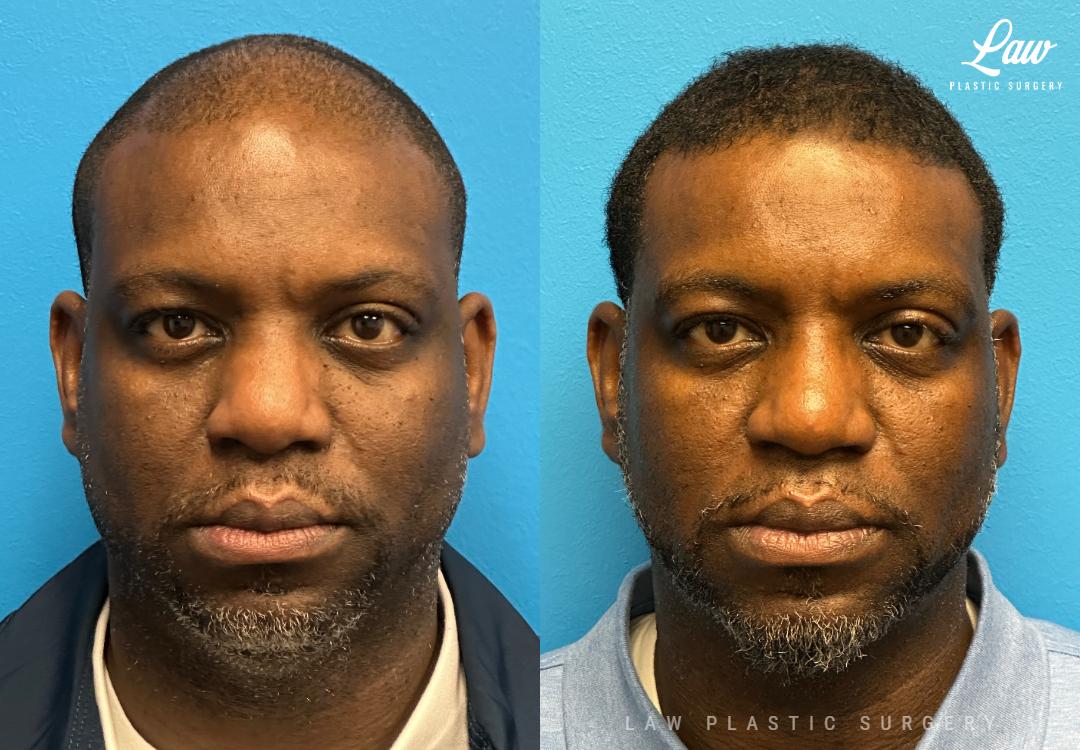 Huay-Zong Law, MD - Law Plastic Surgery rhinoplasty result — Dallas, TX