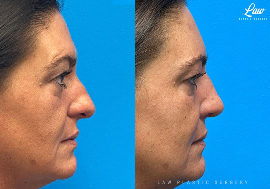 Huay-Zong Law, MD - Law Plastic Surgery rhinoplasty result — Dallas, TX