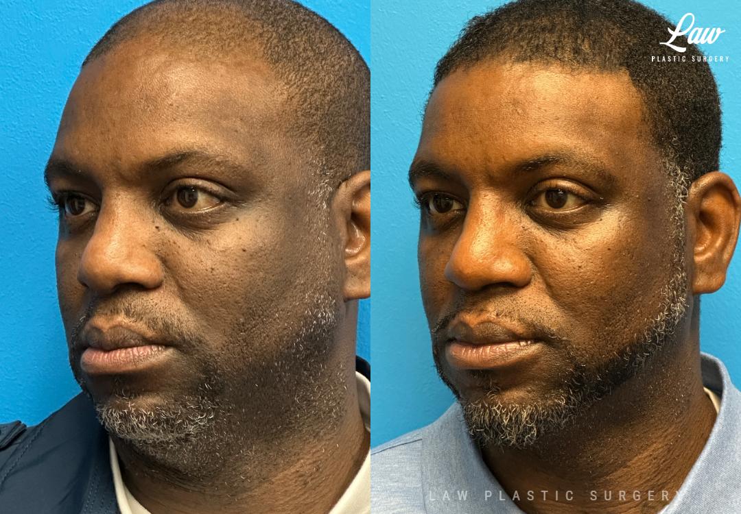 Huay-Zong Law, MD - Law Plastic Surgery rhinoplasty result — Dallas, TX