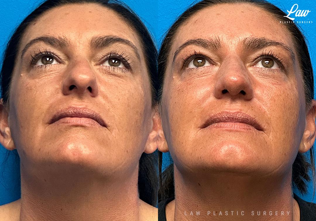 Huay-Zong Law, MD - Law Plastic Surgery rhinoplasty result — Dallas, TX