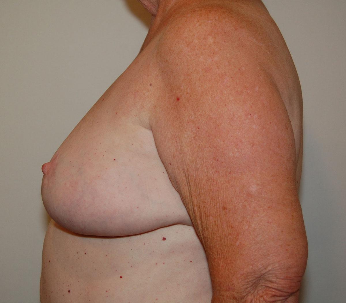 Dr. Jeffrey Umansky breast reduction after — San Diego, CA