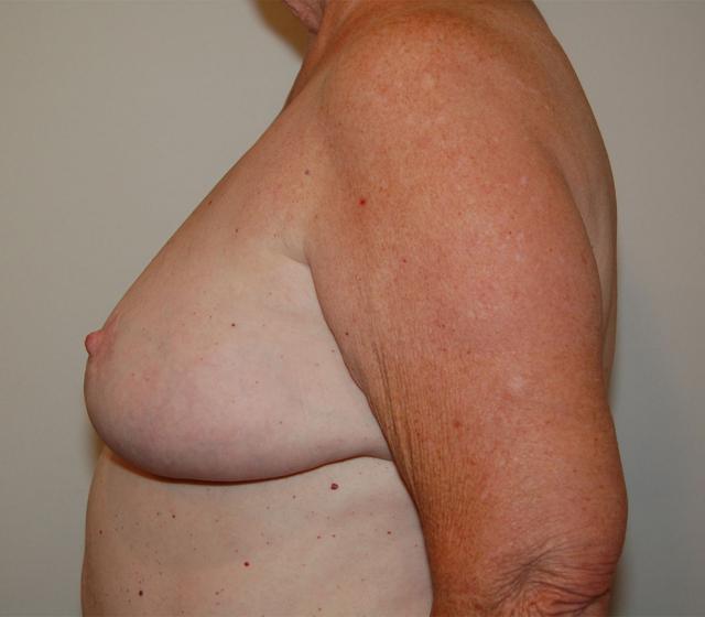 Breast Reduction after at Dr. Jeffrey Umansky in San Diego, CA