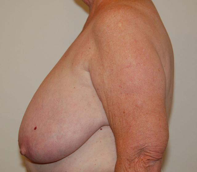 Breast Reduction before at Dr. Jeffrey Umansky in San Diego, CA