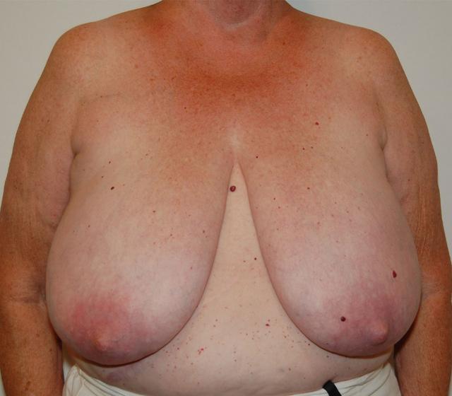 Breast Reduction before at Dr. Jeffrey Umansky in San Diego, CA