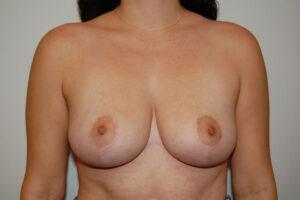 Breast Lift after at Dr. Jeffrey Umansky in San Diego, CA