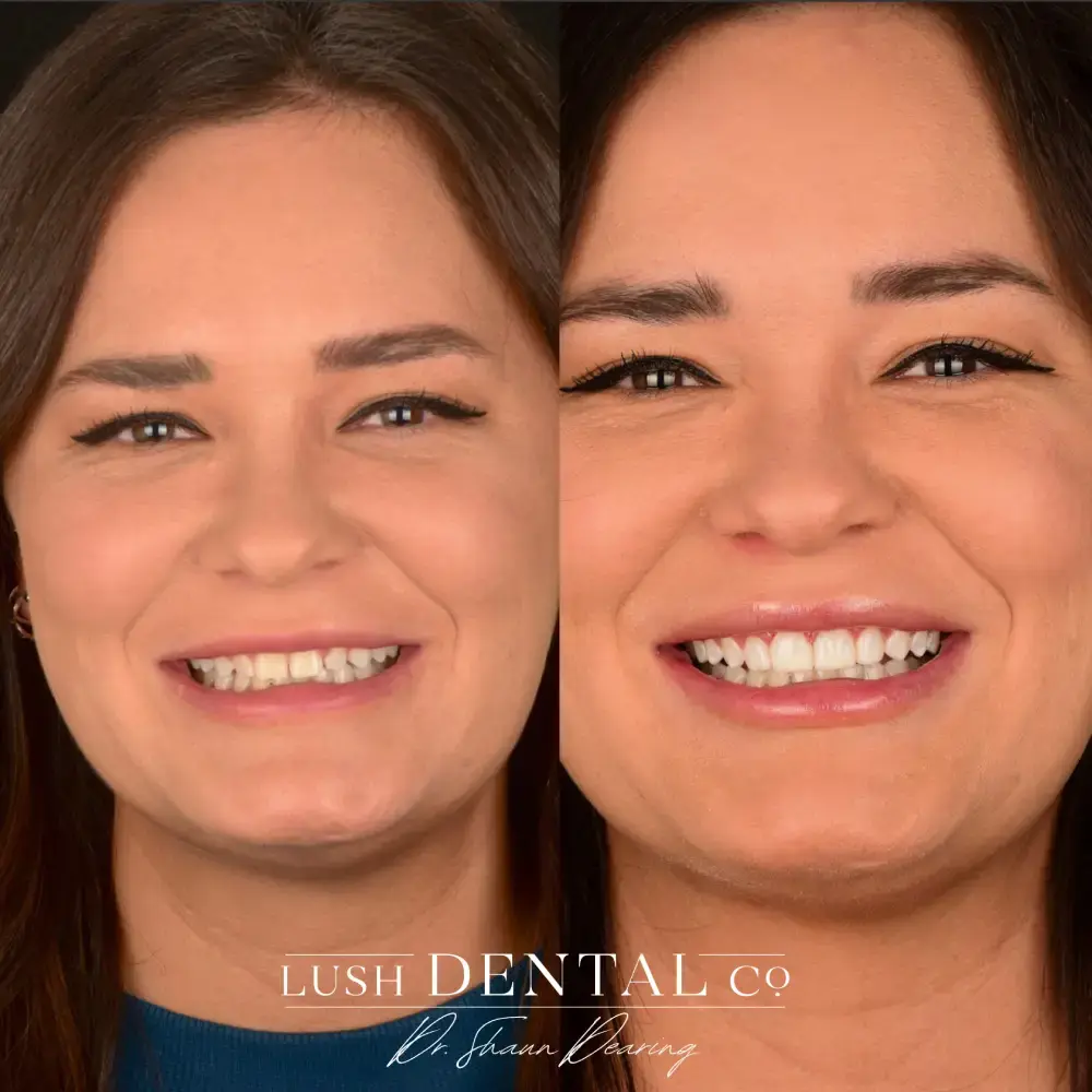 Lush Dental Co. veneers result — Highland, UT