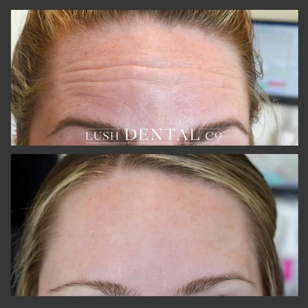Lush Dental Co. botox result — Highland, UT