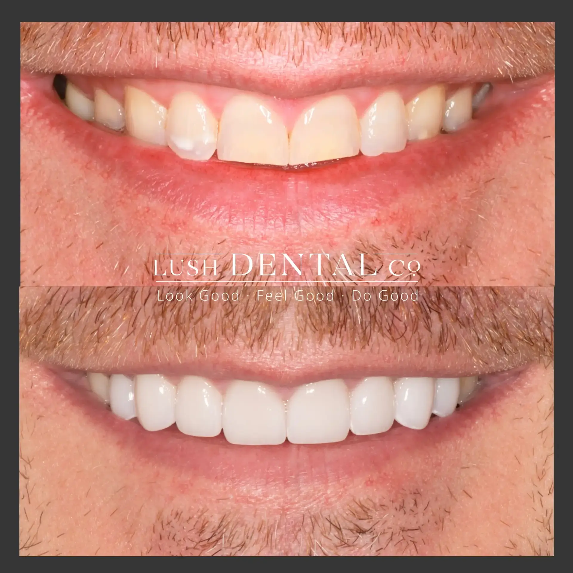 Lush Dental Co. veneers result — Highland, UT