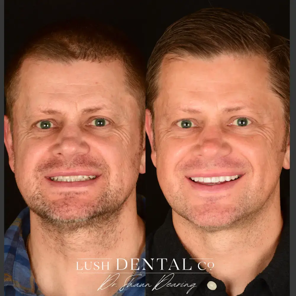 Lush Dental Co. veneers result — Highland, UT